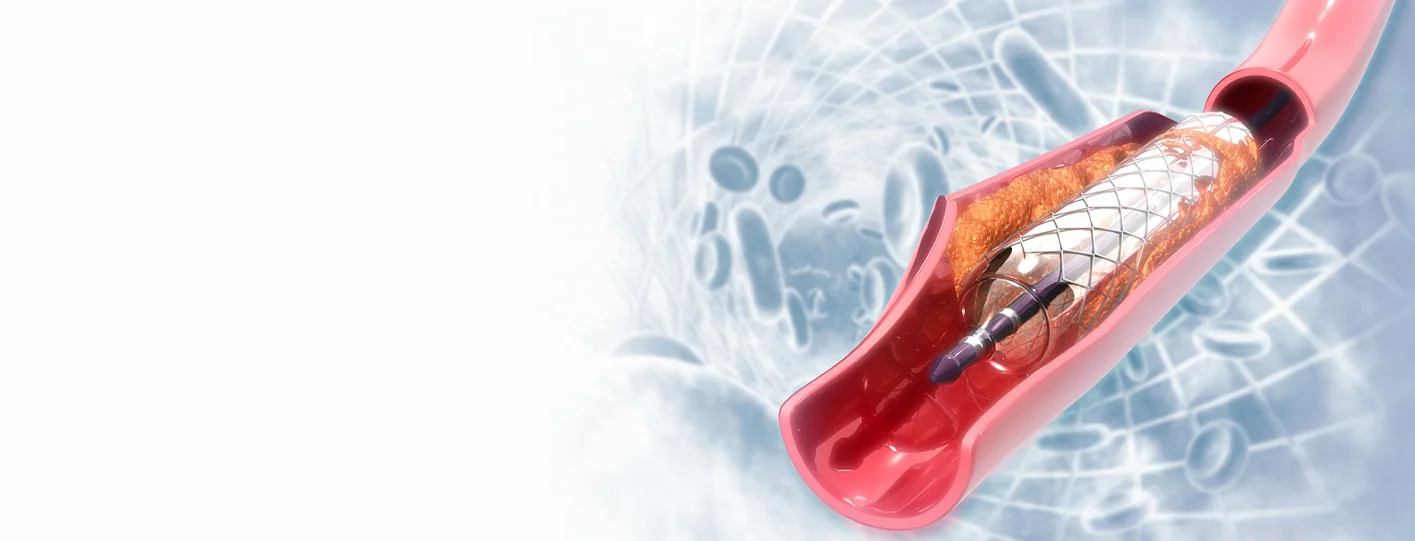 Best Angioplasty Hospital in Ranchi for Emergency Heart Blockage Treatment